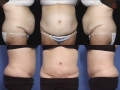 Abdominoplasty 2