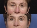 Blepharoplasty 4