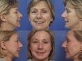 Blepharoplasty 8