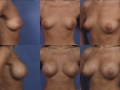 Breast augmentation 12
