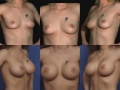 Breast augmentation 2