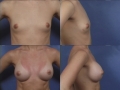 Breast augmentation 22