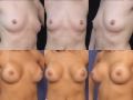 Breast augmentation 6