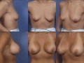 Breast augmentation 8