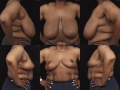 Breast lift 6