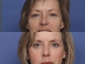 Facial Chemical peel 2