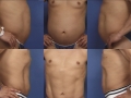 Liposuction 1