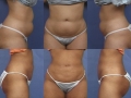 Liposuction 2