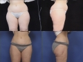 Liposuction 3