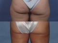 Liposuction 4