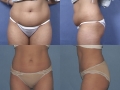 Liposuction 5