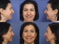 rhinoplasty-12