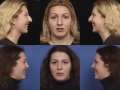 rhinoplasty-13