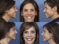 rhinoplasty-15