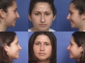 rhinoplasty-2