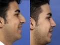 rhinoplasty-8