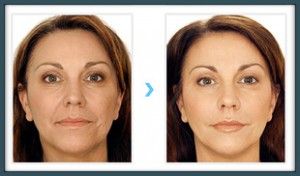  Hyaluronic Acid Filler